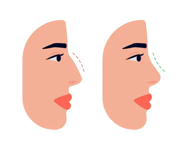 Can Rhinoplasty change your face?