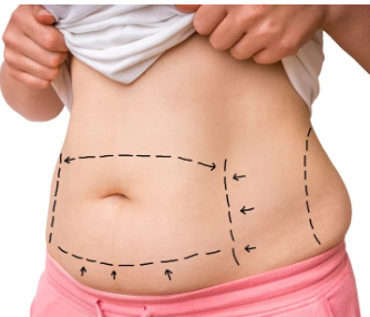 A Beginner’s Guide to Tummy Tucks (Abdominoplasty) 