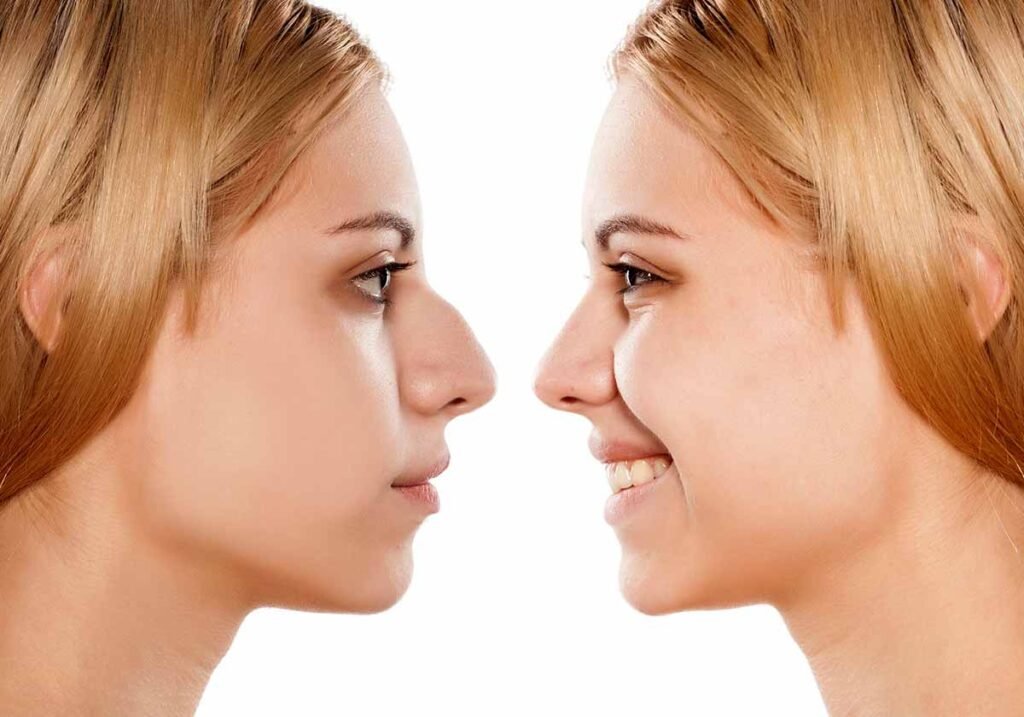 What Are the Long-Term Benefits of Rhinoplasty? 