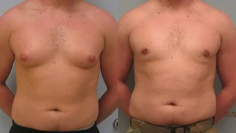 How Does Gynecomastia Surgery Improve Men’s Confidence? 