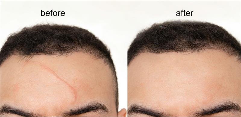 Scar Removal Treatments